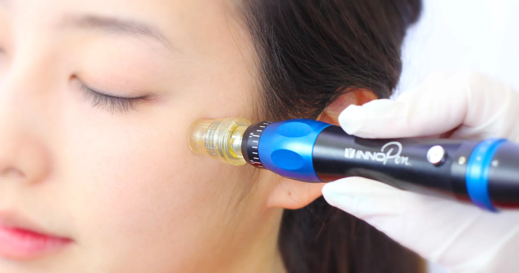 Innopen microneedling device